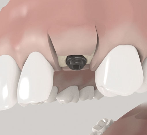 Implantat in einem Schritt