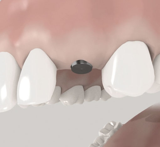 Implantat in zwei Schritten